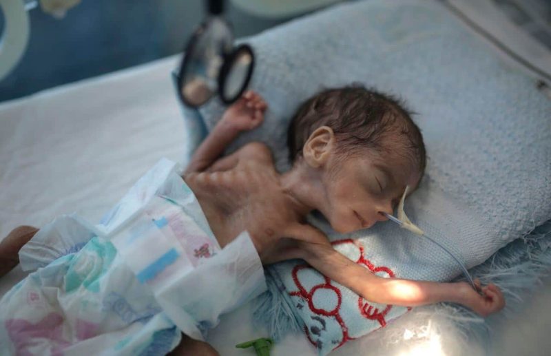 11 ribu anak-anak maut dan cacat di Yaman, ini kisah sebenar yang ramai tidak tahu