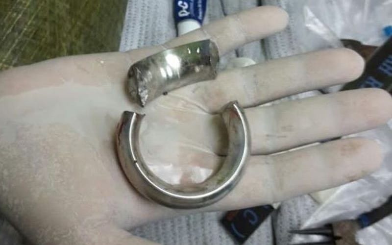 Bomba berjaya keluarkan 5 cincin yang melekat pada kemaluan lelaki